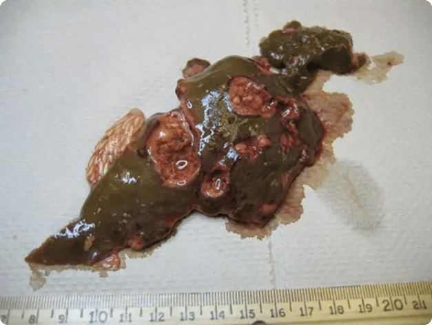 Fish Liver Showing Areas of Necrosis and Damage Due to Systemic Ceratomyxa shasta Infection