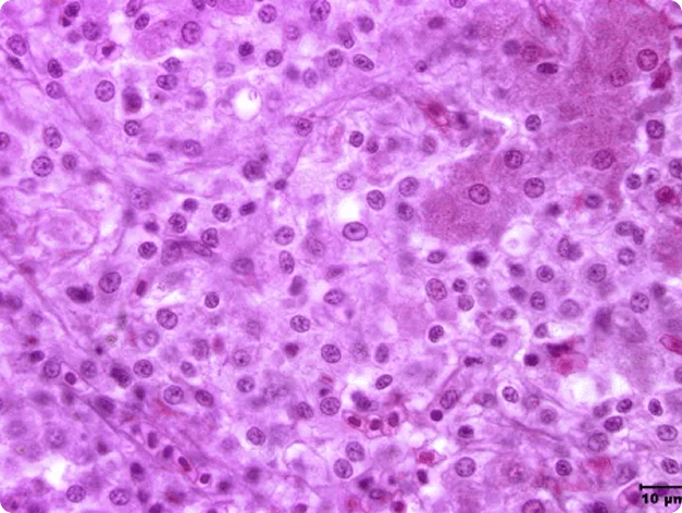 High Magnification View of Liver Hepatocellular Necrosis Caused by Edwardsiella ictaluri