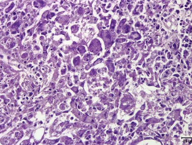 Kidney necrosis and inflammation caused by Renibacterium salmoninarum
