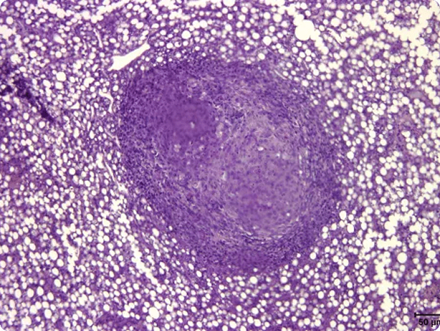 Mycobacterial Lesion in Fish Liver