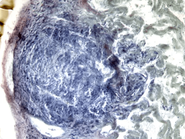 Mycobacterial Lesion in Sculpin