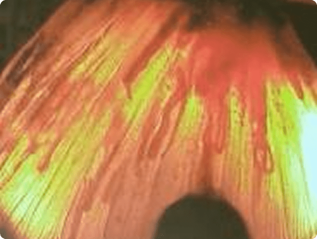 Philometroides Nematodes in Tail of Largescale Sucker