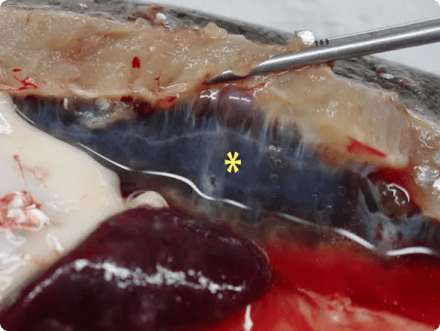 Swollen Kidney (Starred) Due to PKD